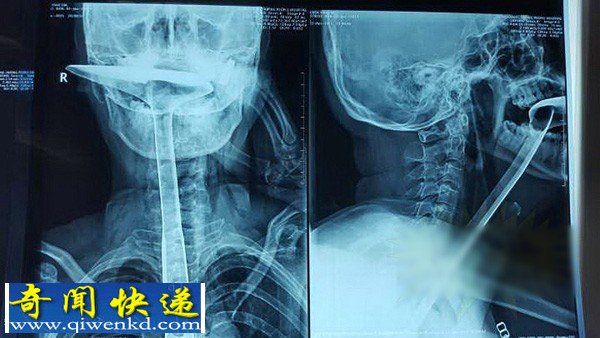 东莞女子将30厘米长锅铲插入食道 怀疑是否精神异常?