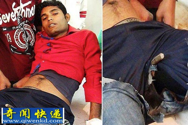 印度男子酒后去工地方便:臀部被铁棒刺穿