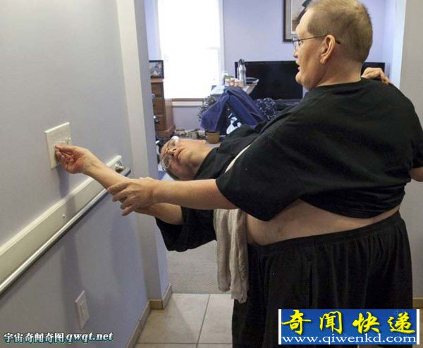 连体人能活多久?世界最长寿连体人63岁
