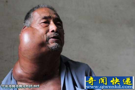 山东聊城:老汉得怪病肿瘤比头大无力治疗陷困境