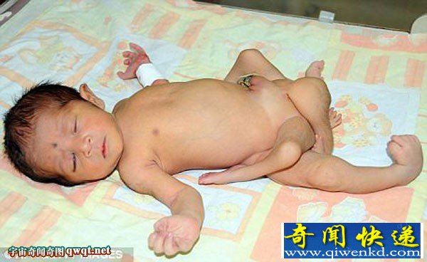 巴基斯坦一名婴儿出生时长了6条腿 其腹长出4肢