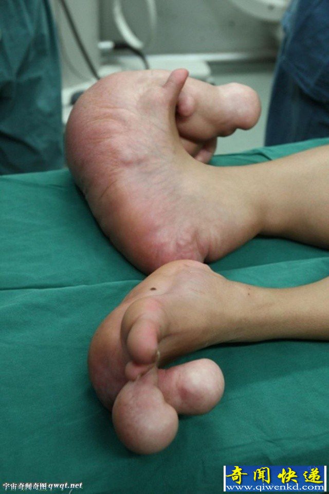 广西瑶族14岁男童患罕见"大脚症 巨足脚趾大如小腿