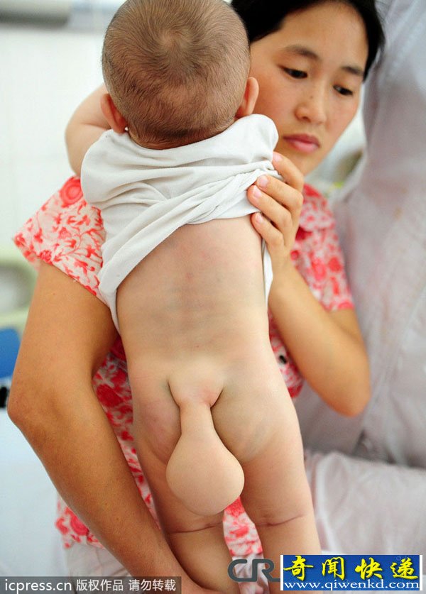 广州7月男婴先天脊柱裂 腰臀部长出“小尾巴”