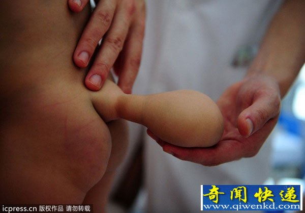 广州7月男婴先天脊柱裂 腰臀部长出“小尾巴”