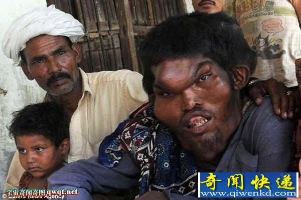 巴基斯坦男子患上怪病成"象人"