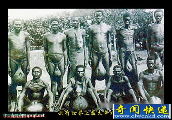 美国男子得怪病长最大睾丸却拒绝免费手术