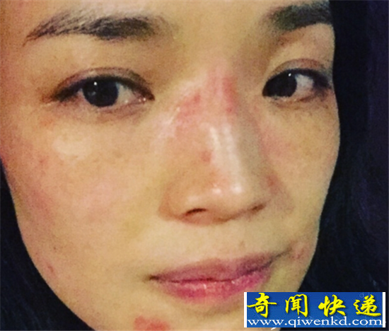 舒淇崩溃晒自拍照 脸部过敏性感女神变成黄脸婆