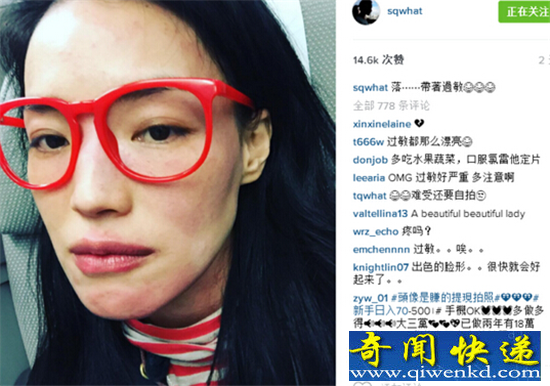 舒淇崩溃晒自拍照 脸部过敏性感女神变成黄脸婆