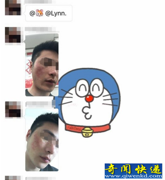 可怕!大学生惨遭毁容流脓 南昌天虹423丧尸跑是什么鬼?