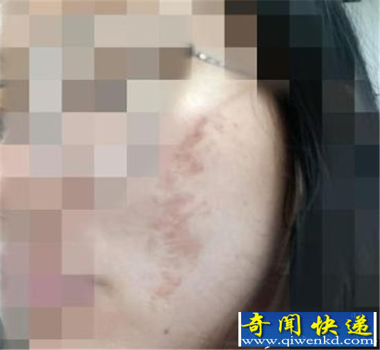 多名大学生毁容 参加丧尸跑活动被商家坑惨