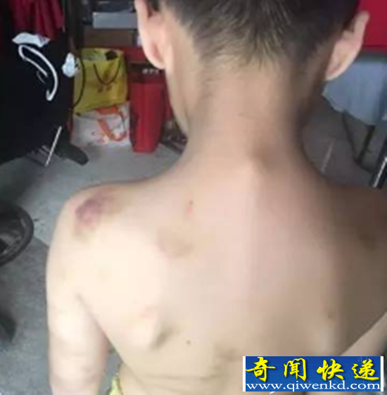 老师嫌孩子笨 竟用衣架抽打孩子致浑身淤青