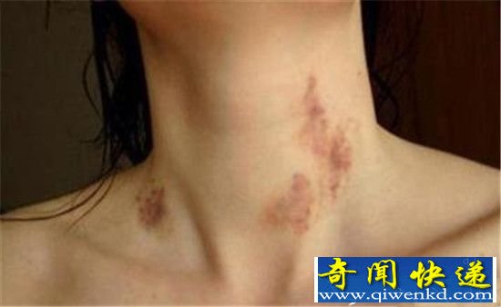 女孩因在男友身上留吻痕 被准婆婆赶出家门