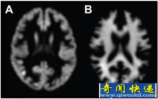 英国研发“深度学习机” 能够自动识别大脑年龄