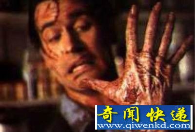 异己手综合症