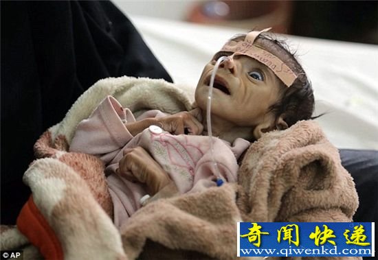 也门的生不如死:婴儿5月大被活生生饿死