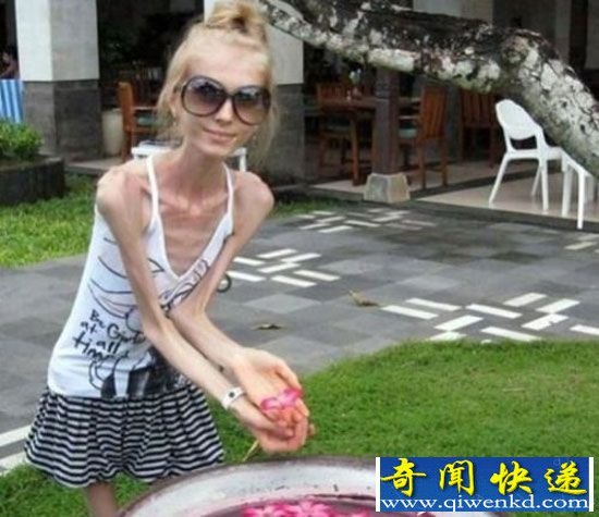 全球最瘦的女人仅20公斤!令人侧目的世界之最