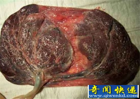 人体胎盘黑市暗访触目惊心 私厨加工牟取暴利钻法律空子!