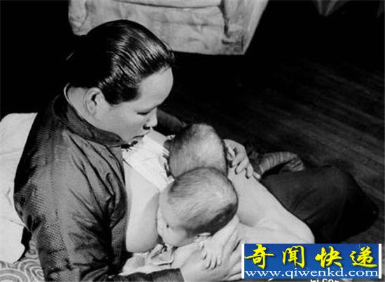 揭秘:上海1947年连体婴 竟然被如此处理