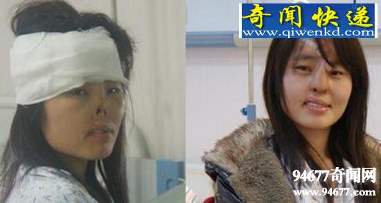 无鼻女3岁被老鼠咬掉鼻子,整形后蜕变准新娘