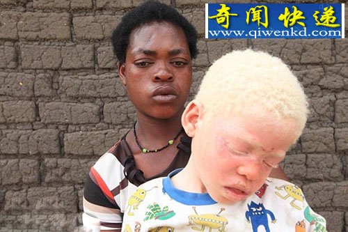非洲白化病男孩难逃杀戮!