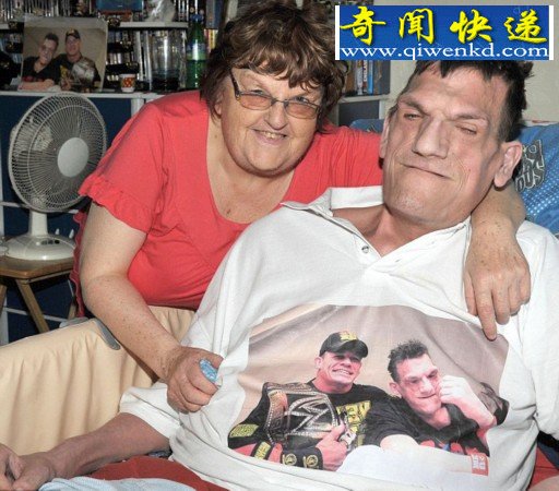 英“巨人症”男子身高超2米仍在长