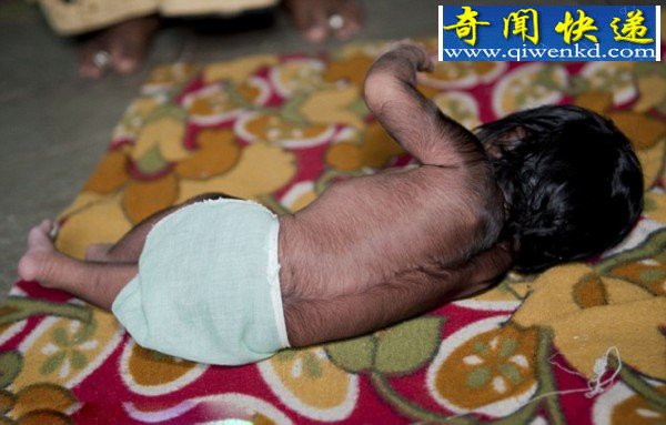印度女婴遗传多毛症 体毛多似狼孩