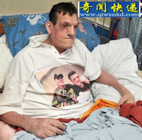 英“巨人症”男子身高超2米仍在长