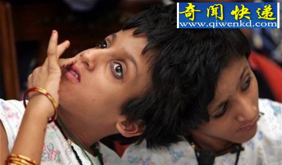 两人一个身体的恐怖变异连体人(组图)