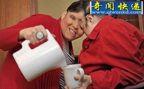 两人一个身体的恐怖变异连体人(组图)