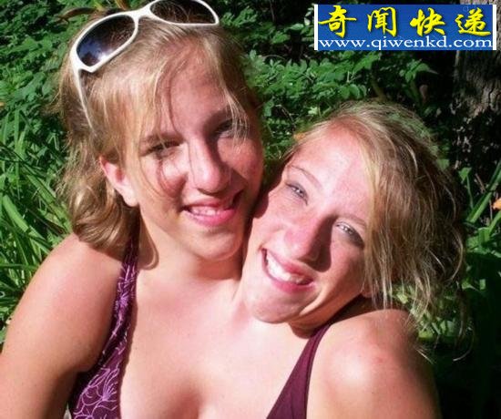 两人一个身体的恐怖变异连体人(组图)