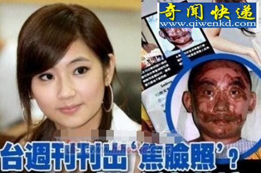 任家萱烧伤图片曝光,疤痕太吓人(惨遭老公抛弃)