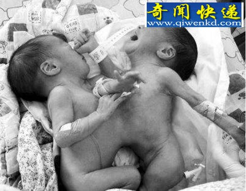 中国首例成功分离连体婴儿,如愿考上大学健康成长