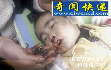 重庆男孩疑似外星人附体 咳出一尺长“异形”