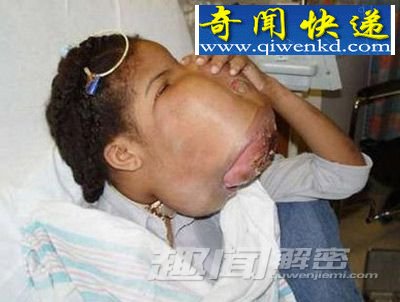 细数全球最恐怖的十大怪病!