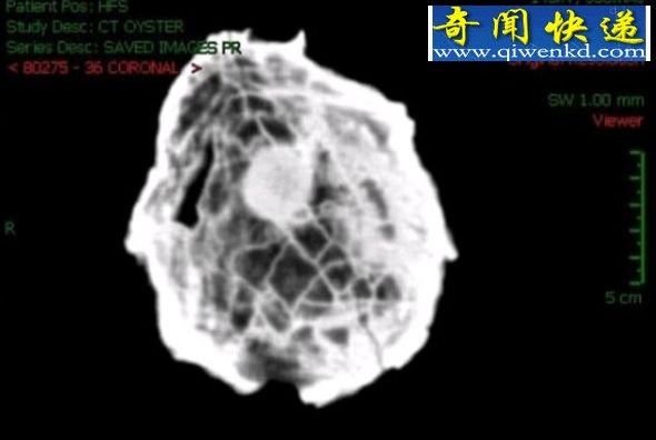 内部有个圆状物体:核磁共振成像扫描显示的这个位于巨大牡蛎内部的神秘圆状物体很可能是颗大珍珠。 英国牡蛎化石可能含有世界最大珍珠