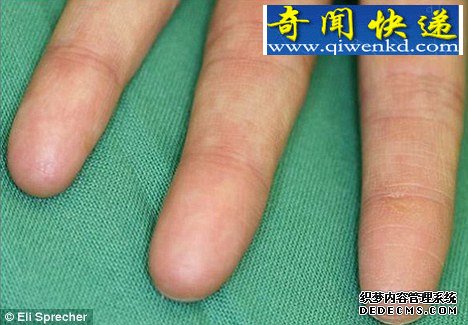 皮纹病患者天生没有指纹 以科学家发现基因突变致少数人天生没有指纹