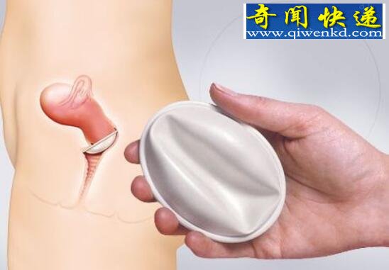 古代人怎么避孕,子宫套(折磨女性的器具)