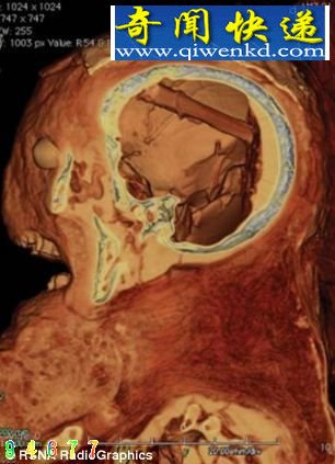 科学家在木乃伊头骨内发现的大脑移除工具,使用竹子制成 距今2400年木乃伊头骨内发现大脑移除工具